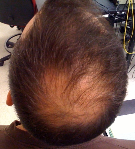 Most authentic hair loss treatment at home without any products